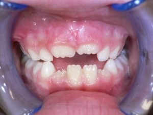 4.denticion mixta