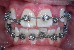 brackets valencia