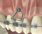 Microtornillos en ortodoncia