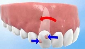ortodoncia invisible Invisalign