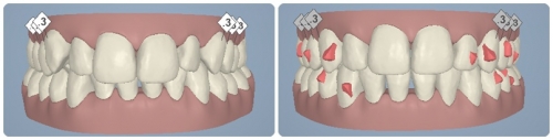 ortodoncia invisible Invisalign