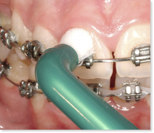 cuidados dentales con ortodoncia