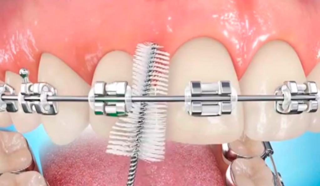 Cuidados dentales en ortodoncia con brackets