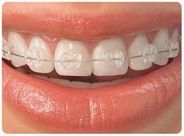Tipos de ortodoncia