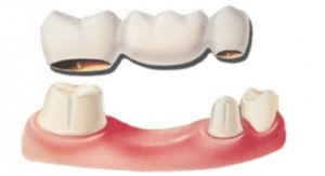 Colocación-puente-dental-350x190