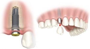 colocación-diente1